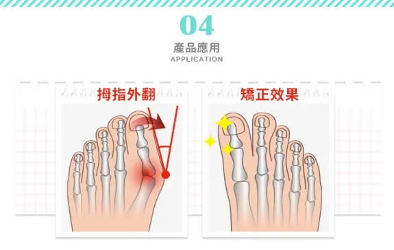 3-2拇指外翻矯正器