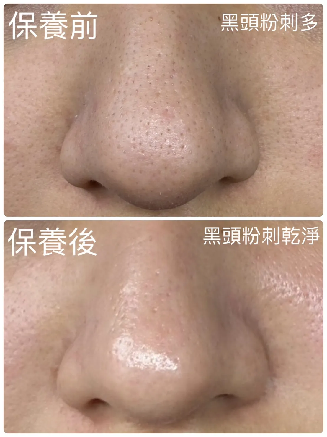 鼻頭黑頭粉刺保養