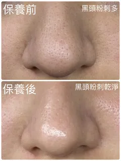 鼻頭黑頭粉刺保養