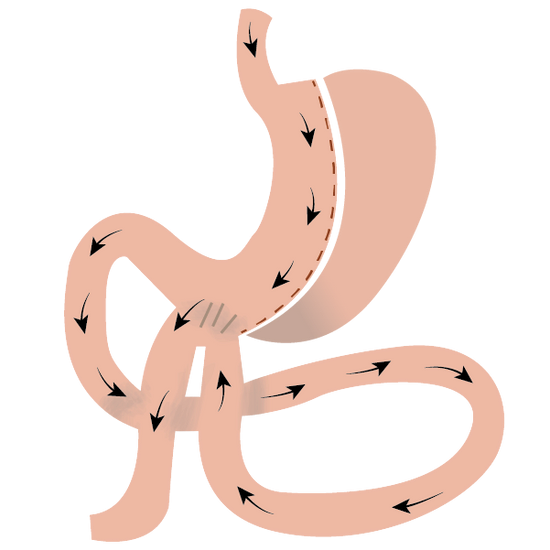 單吻合迴腸雙通道胃繞道手術（SASI胃縮手術）