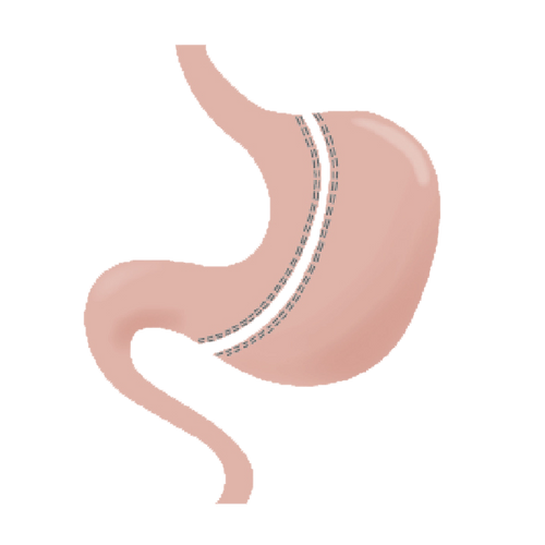 腹腔鏡胃袖狀(縮胃)切除手術