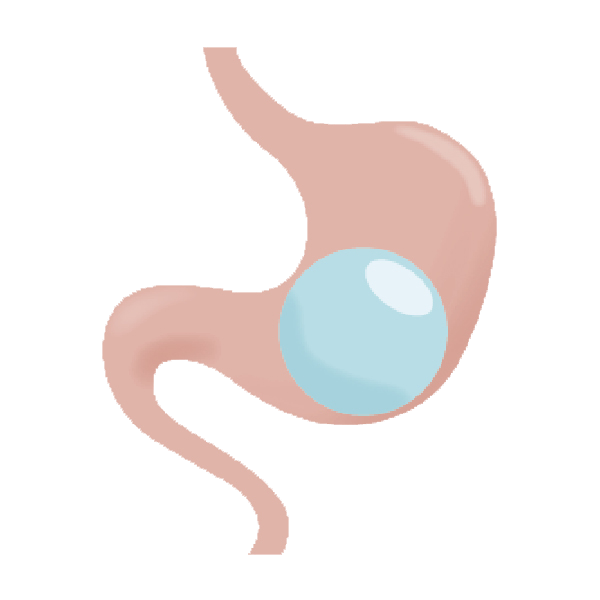 胃鏡胃內水球