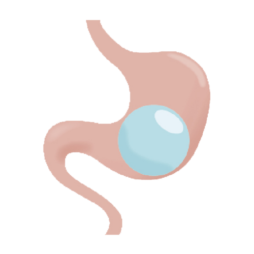 胃鏡胃內水球