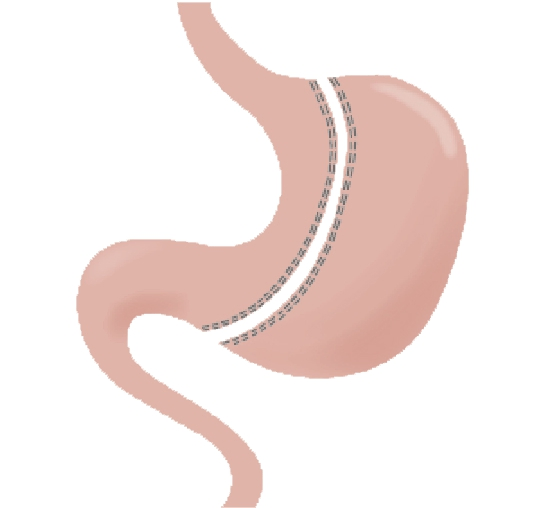 胃袖狀切除手術-SleeveGastrectomy