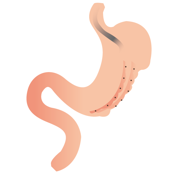 內視鏡袖狀胃整形術(胃鏡縮胃)