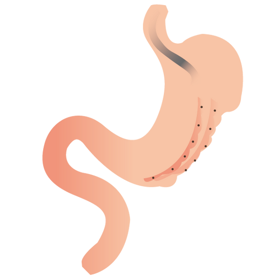 內視鏡袖狀胃整形術(胃鏡縮胃)