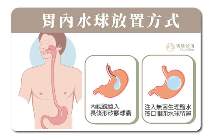 透過胃水球填充胃部空間、減少胃容量