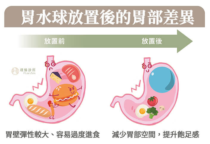 胃水球可減緩進食速度、降低食物攝取量