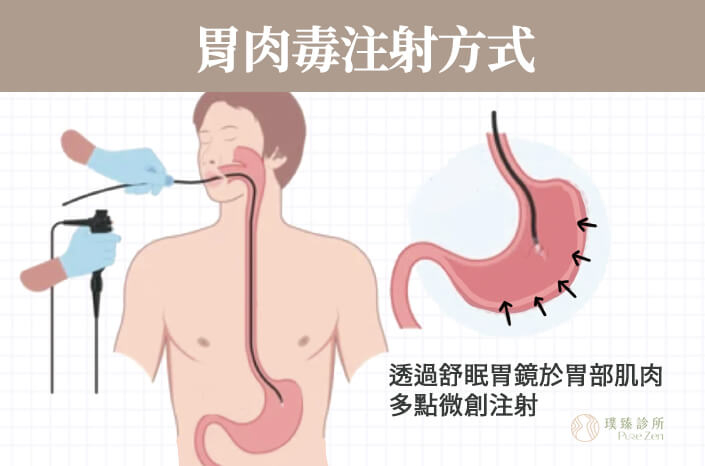 胃肉毒減重採舒眠胃鏡技術於胃部平滑肌多點微創注射