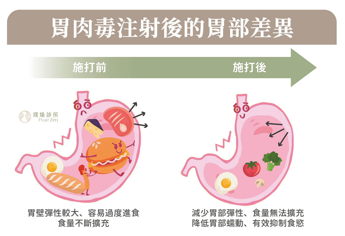 胃肉毒能減少胃部肌肉的擴充性，延長胃排空的時間