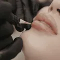 韓式嘟嘟唇解析