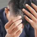 男性頭皮保養關鍵